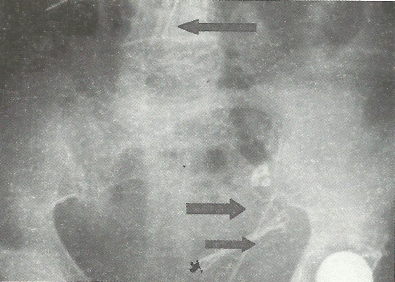 Sindrome di Munchausen