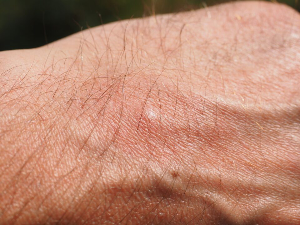 Mosquito Bite 2117420 1920
